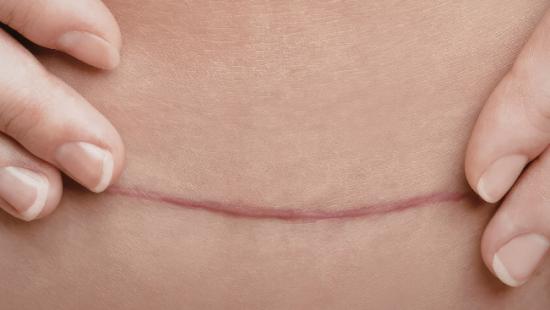 Abdominoplasty Scar