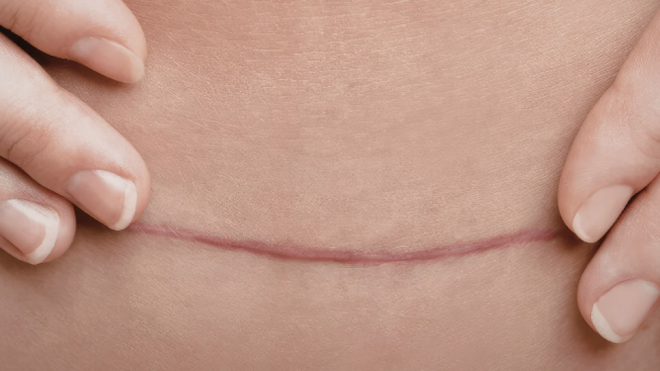 Abdominoplasty Scar