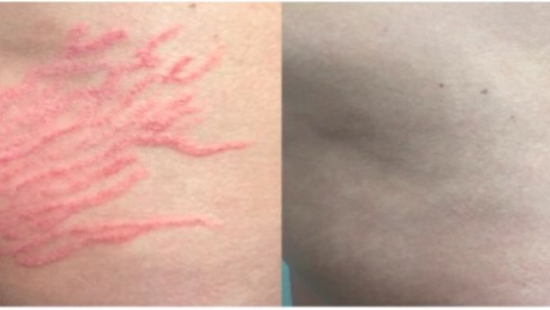 Stretch Mark Treatment Real Before and After Results by Camuflatrix