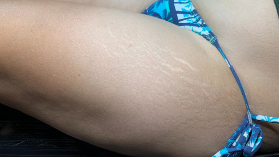 White Stretch Marks
