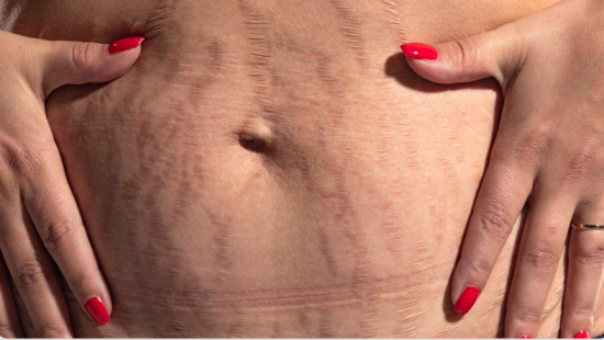 red stretch marks