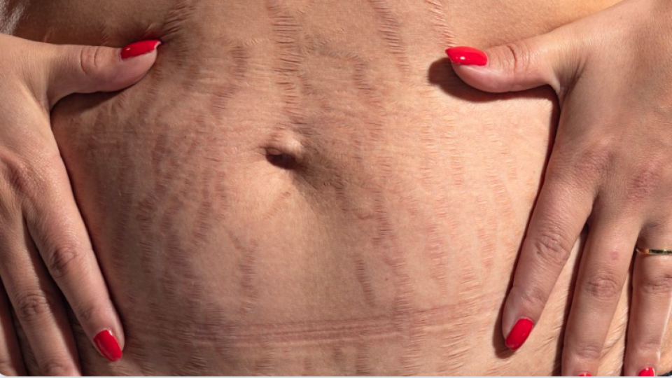 red stretch marks